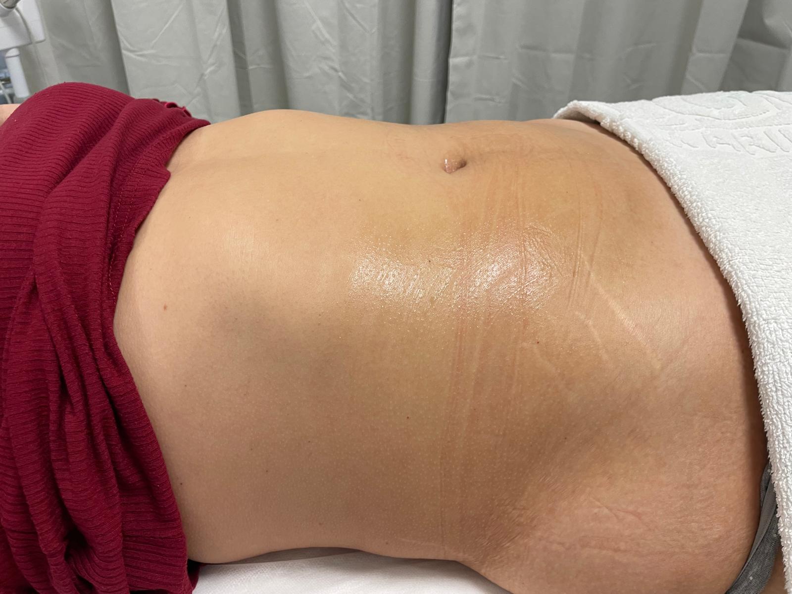 Preparação para sessão de vacuoterapia com produto aplicado