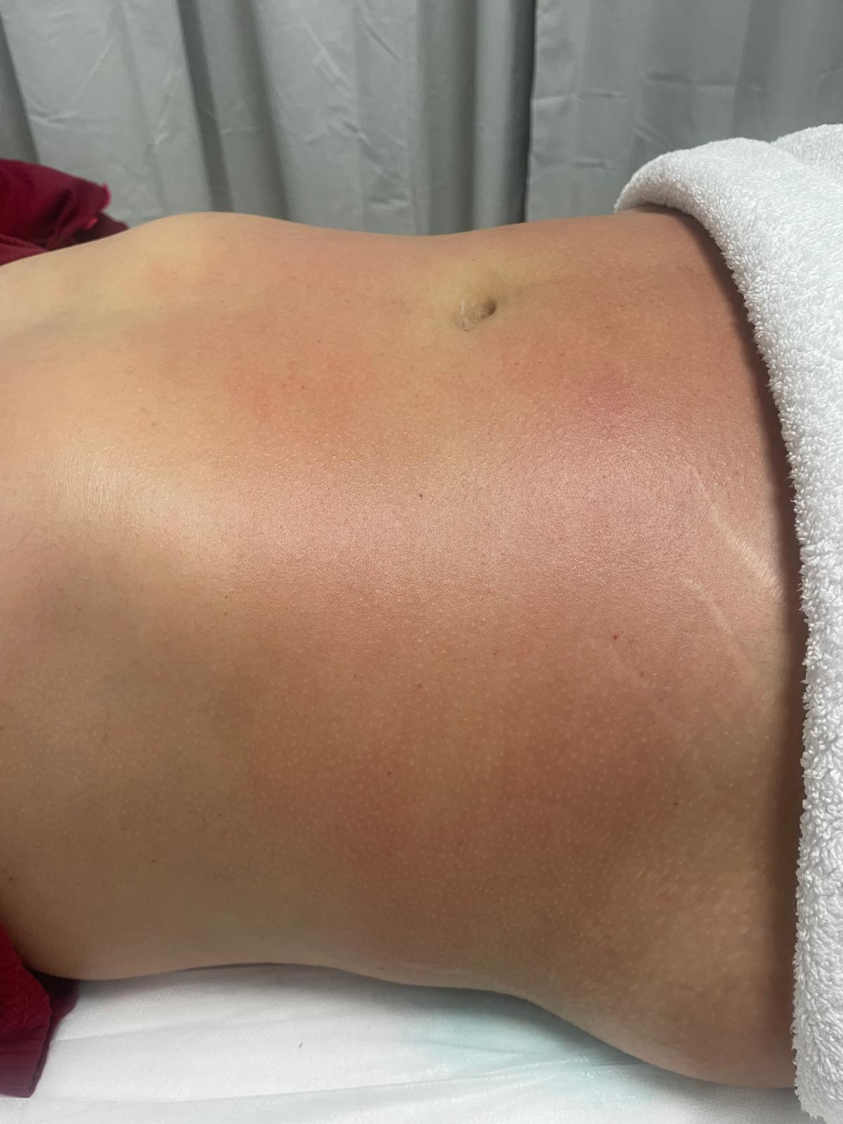 Resultado de sessão de vacuoterapia — pele lisa e uniforme